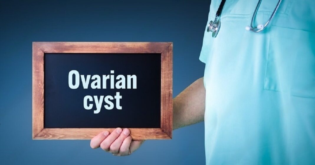 ovarian-cyst-symptoms-an-ultimate-guide this blog is very interesting and captivating about ovarian cyst symptoms.